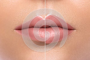 Comparison of beautiful emale lips after augmentation