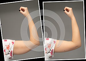 Comparison before and after excess skin removal under woman arm