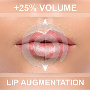 Comparison of female lips after augmentation with filler injections