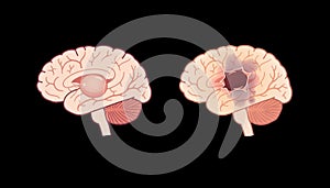 Comparison graphic featuring sidebyside unruptured and ruptured aneurysms delicate color transitions restrained