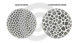 Comparison of healthy bone structure versus osteoporotic bone structure