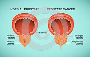 Comparison of Healthy and Cancer Prostate illustration