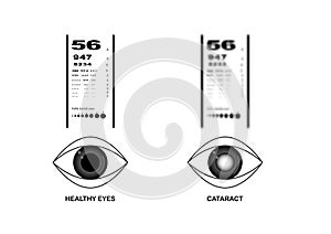 Comparison of healthy eyes and cataract eyes vision on eye examination chart