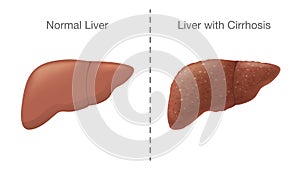 The Comparison between Healthy liver and Cirrhosis. photo