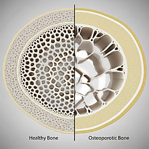 Comparison of Healthy and Osteoporotic Bone Structure