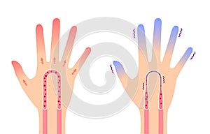 Comparison illustration of normal hand and cold hand  sensitivity to cold, cold fingertips / no text photo