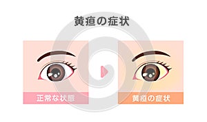 Comparison illustration of normal and jaundiced eyes