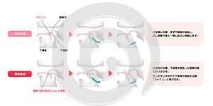 Comparison illustration of normal jaw and Temporomandibular disorders TMD photo