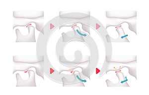 Comparison illustration of normal jaw and Temporomandibular disorders TMD photo