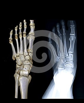 Comparison of left foot AP view 3D rendering image and X-ray image.