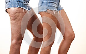 Comparison of legs with and without cellulite