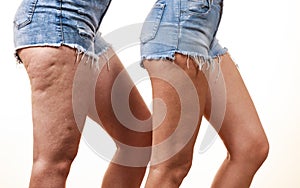 Comparison of legs with and without cellulite photo