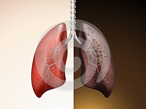 Comparison of lung care