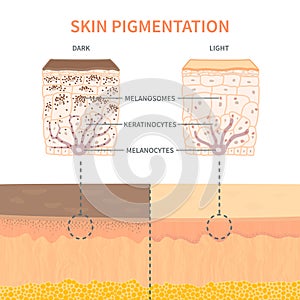 Skin tone pigmentation mechanism infographic medical diagram photo