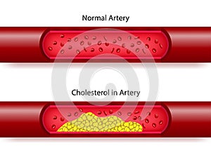 Comparison between normal artery and cholesterol