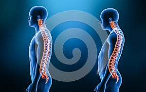 Comparison between normal backbone and lordosis curvature of the spine with man model from lateral view 3D rendering illustration