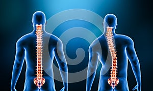 Comparison between normal backbone and scoliosis curvature of the spine with male model from back view 3D rendering illustration.