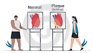 Comparison of normal heart and coronary artery disease. Plaque buildup can creat of deposits of cholesterol in the artery.