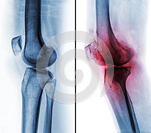 Comparison between normal human knee & x28; left image & x29; and osteoarthritis knee & x28; right image & x29; . Lateral view