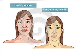 The Comparison between normal skin people and yellowing from Jaundice