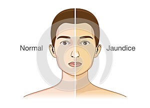 The Comparison between normal skin people and yellowing from Jaundice.