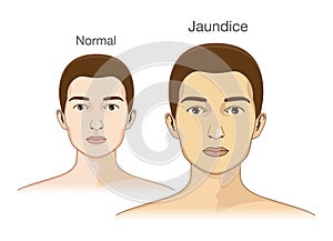 The Comparison between normal skin people and yellowing from Jaundice. photo