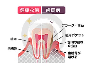 Comparison of normal teeth and periodontal disease. flat vector illustration