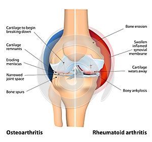 Comparison of Osteoarthritis and Rheumatoid Arthritis