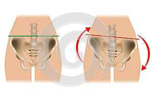 Comparison of pelvic distortion. Normal pelvis and distorted pelvis. Twisted Pelvis or Pelvic Torsion