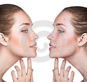 Comparison portrait of problematic skin