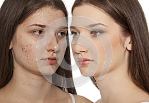 Comparison portrait of teenage girl with problematic skin, before and after skin treatment