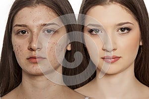 Comparison portrait of teenage girl with problematic skin, before and after skin treatment