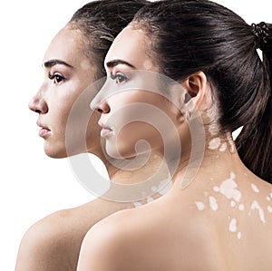 Comparison portrait of young woman with and without makeup.