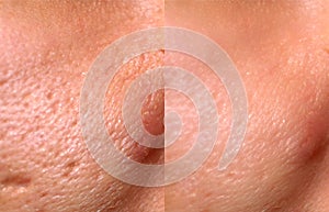 Comparison of skin before and after laser resurfacing. Skin with acne, acne scars, enlarged pores.