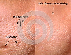 Comparison of skin before and after laser resurfacing. Skin with acne, acne scars, enlarged pores.