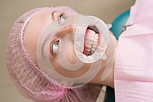 Comparison after teeth whitening. Make models and measurements for dental appliances, such as dentures, to fit patients