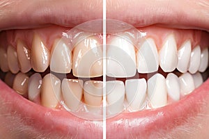 Before and after comparison of teeth whitening process with a focus on dental care