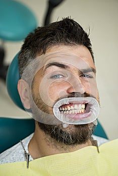 Comparison after teeth whitening. Teach patients about diets, flossing, the use of fluoride, and other aspects of dental