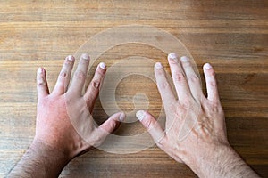 Comparison of two male hands stung by bee or wasp. Hand swelling, inflammation, redness are signs of infection. Insect bite on