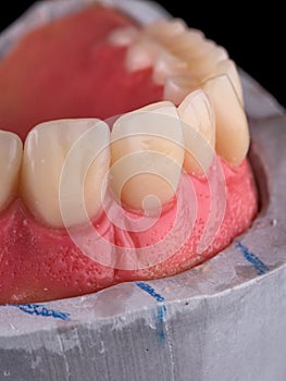 Complete maxillary denture â€“ Wax-Up and Gingival Contouring