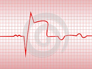 Complex of ECG