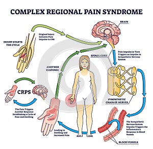 Complex regional pain syndrome or CRPS as painful condition outline diagram photo