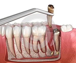Complex tooth extraction. Medically accurate 3D illustration of dental treatment