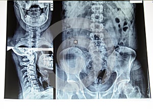 Complex x-ray with cervical and lombar spine