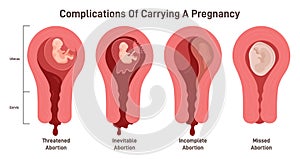 Complications of carrying a pregnancy. Miscarriage danger, separation