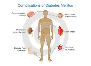 Complications of Diabetes Mellitus.