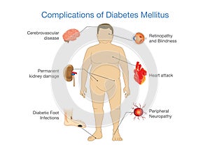 Complications of Diabetes Mellitus.