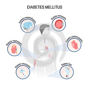 Complications of diabetes mellitus