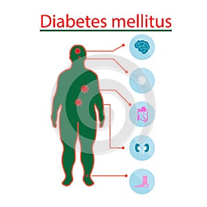 Complications of Diabetes Mellitus in fat people. Illustration in Infographic style about medical and health.