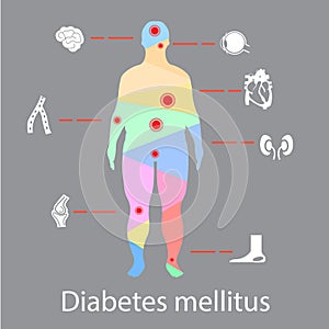 Complications of Diabetes Mellitus in fat people. Illustration in Infographic style about medical and health.